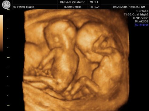 Resultado de imagen de el preembrión sea ser humano